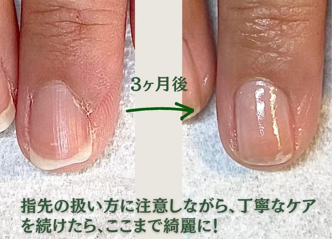 ペンだこの改善にはプロのケアもおすすめ｜松山市で自爪育成するならnail ambleへ