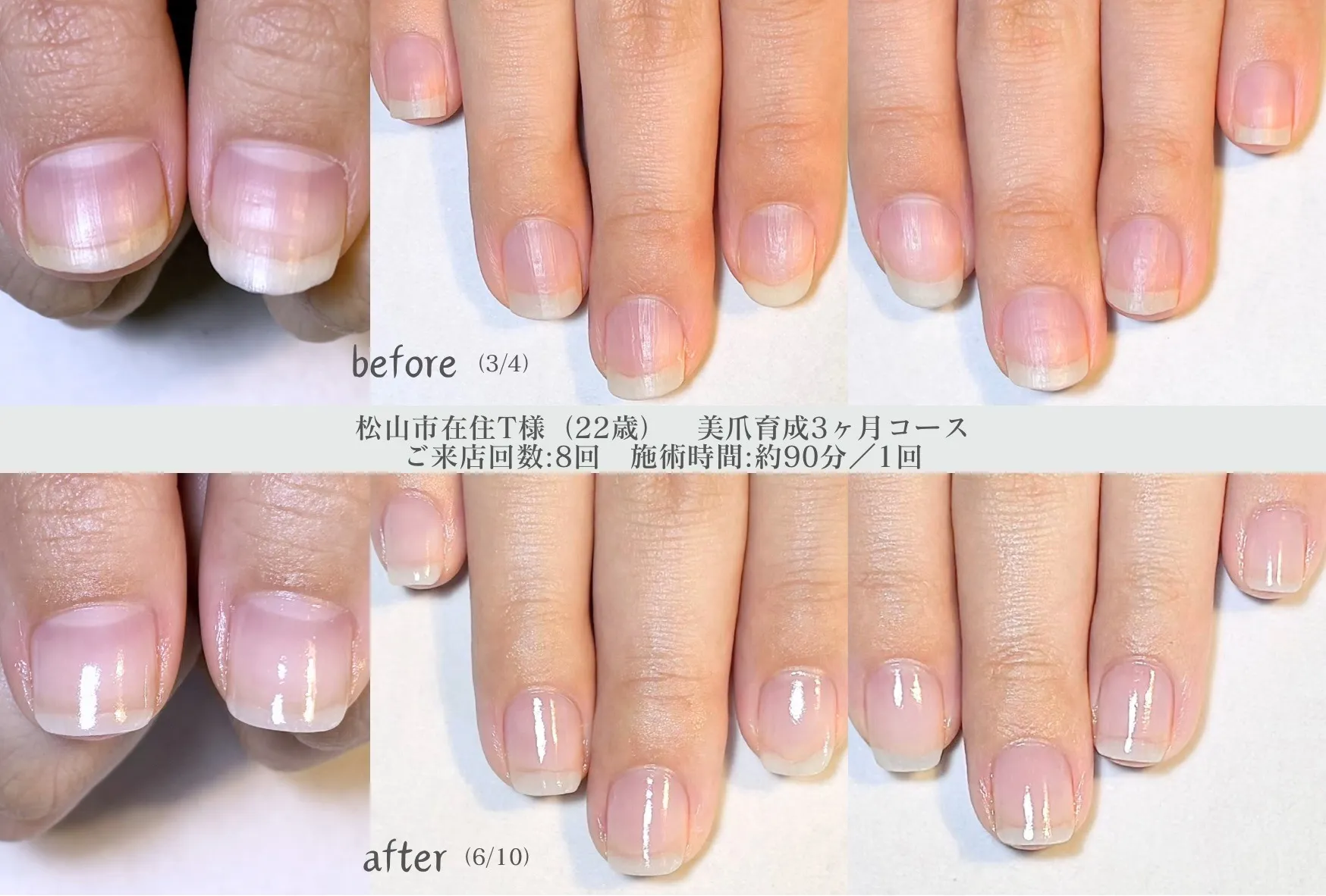 美爪育成3ヶ月コース【松山市在住T様】