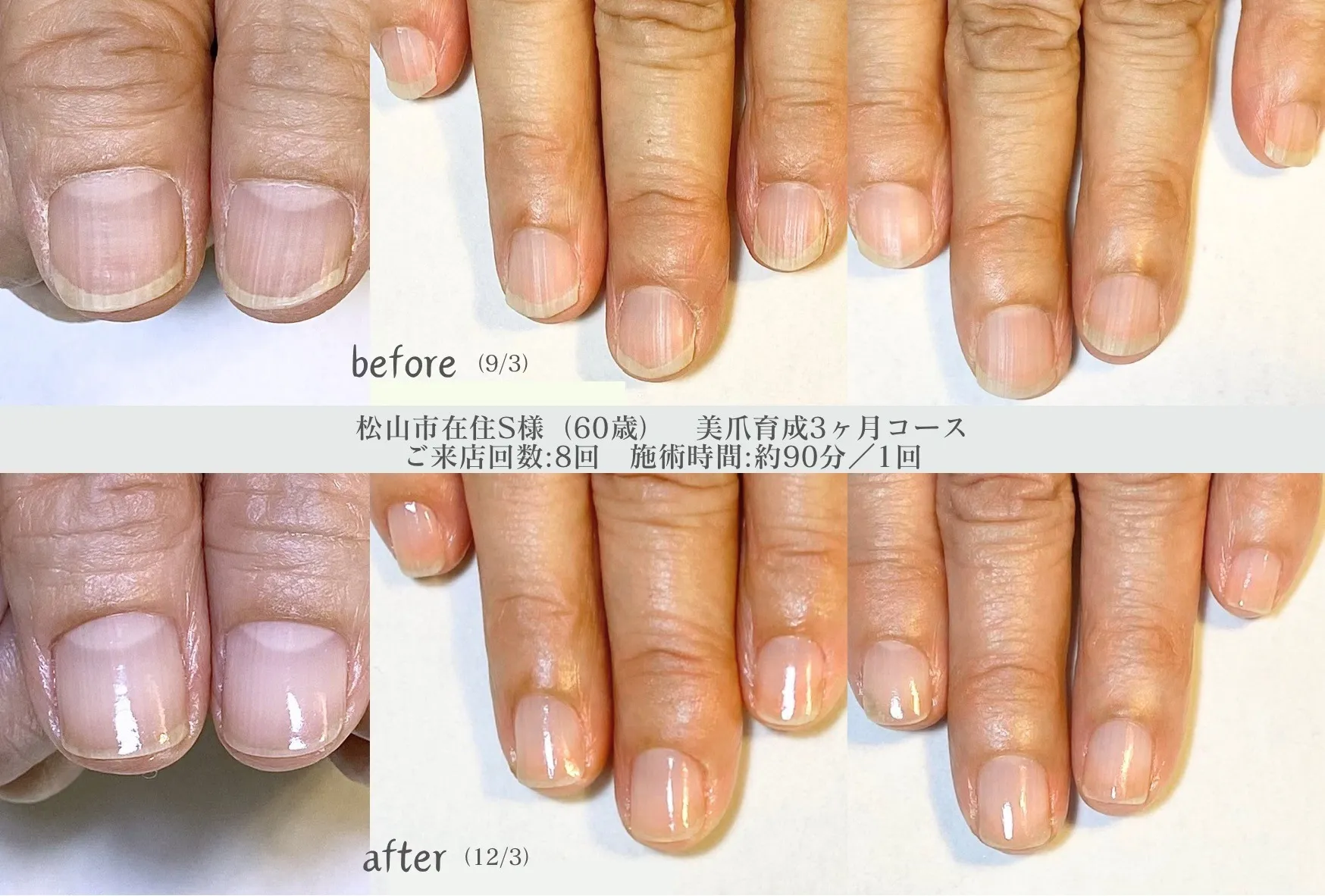 美爪育成3ヶ月コース【松山市在住S様】